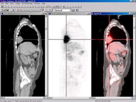 CT and PET Image Fusion