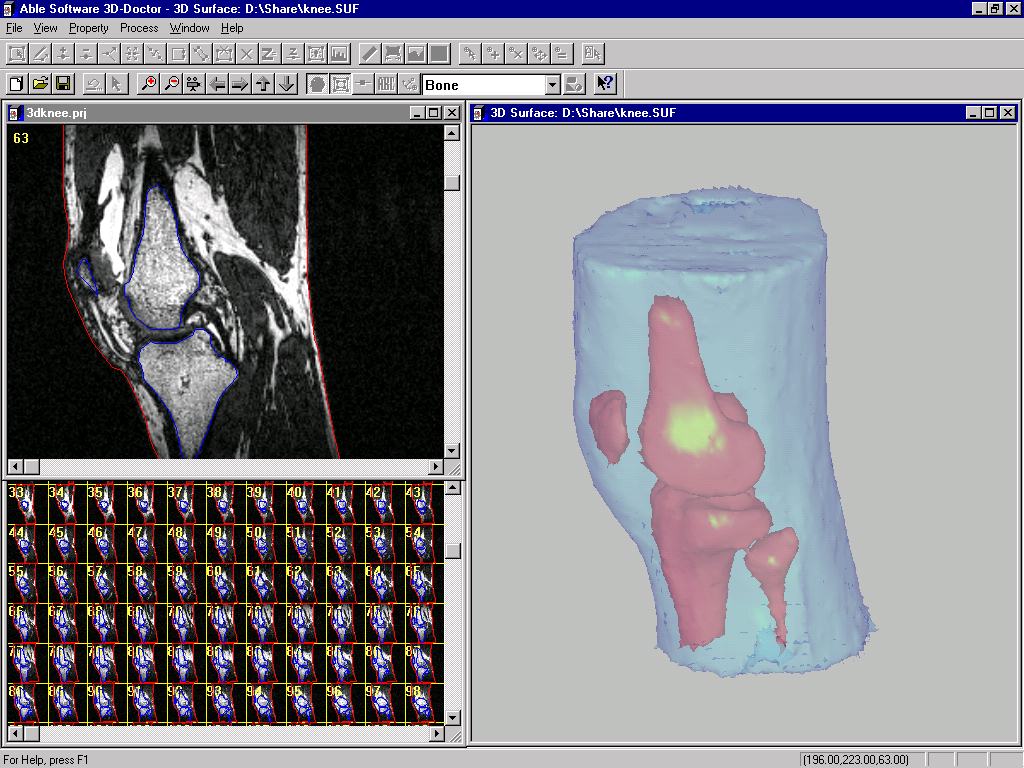 Volumetric Rendering of a knee